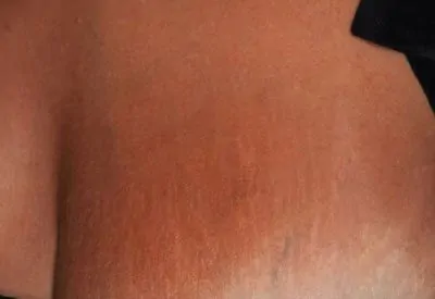 m22-chest-stretch-marks-after