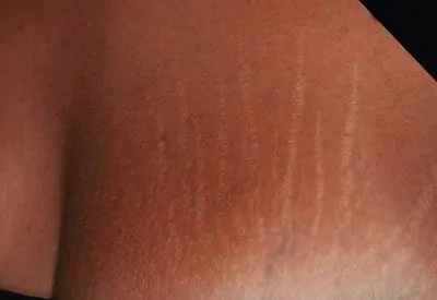 m22-chest-stretch-marks-before