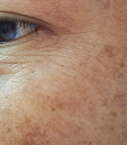 Best Treatment For Age Spots Cheshire