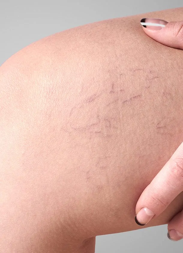 IPL Photorejuvenation on Face Veins with BBL After
