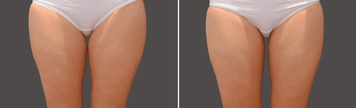 coolsculpting-legs-before-after-dr-nyla
