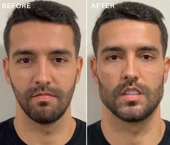 Before and after jawline dermal filler