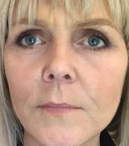 Transformational Facelift after 3