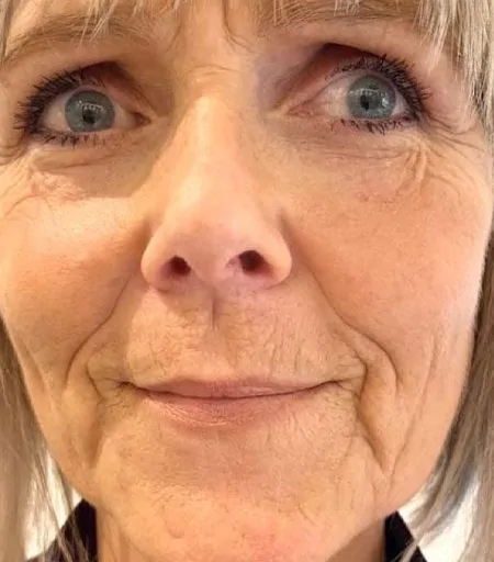 Transformational Facelift before 3