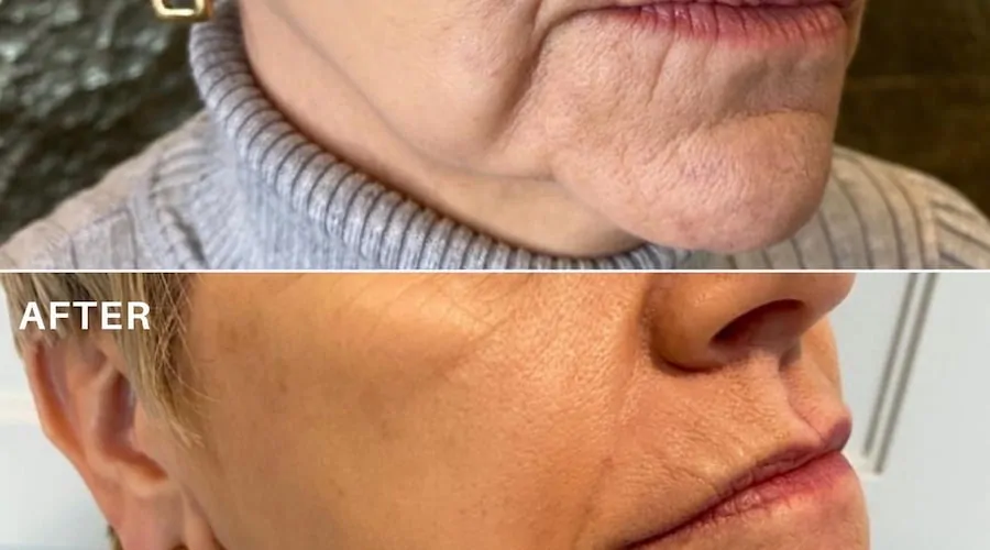 Sagging jowls before and after