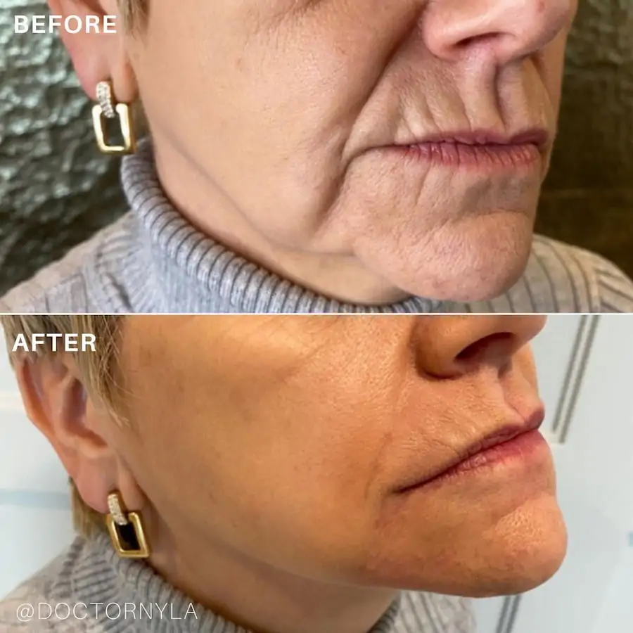 Sagging jowls before and after