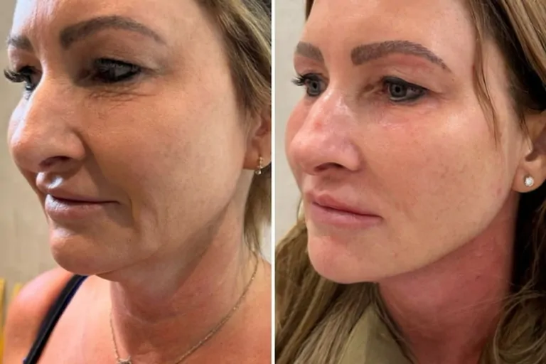 Jawline filler before and after
