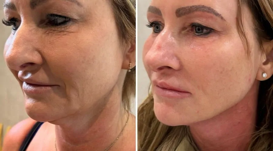 Jawline filler before and after
