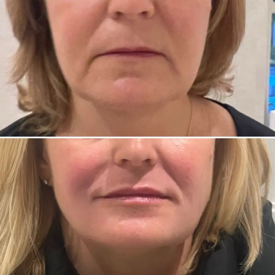 Sagging jowls before and after
