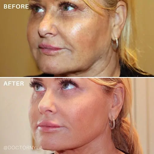 Dr Nyla Transformation Skin Tightening