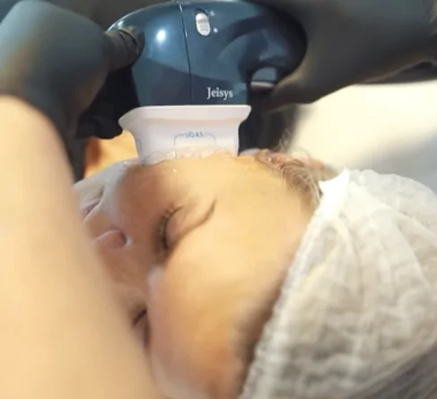 Ultracel Facelift skin tightening