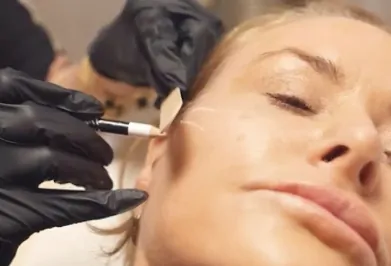 Anti-Wrinkle Treatment