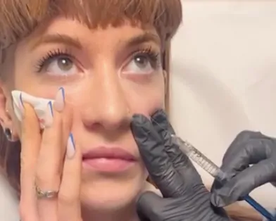Provider injecting tear trough filler beneath the eye to reduce under-eye hollows and improve dark circles.