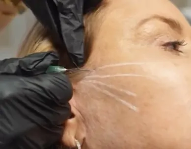 Feathering Filler Treament