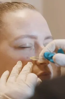 Injector performing tear trough filler treatment to reduce under-eye hollows and dark circles with dermal filler