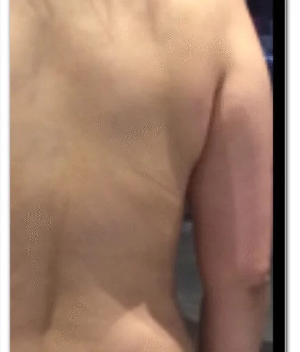 Aqualyx Fat Dissolving on Flanks After