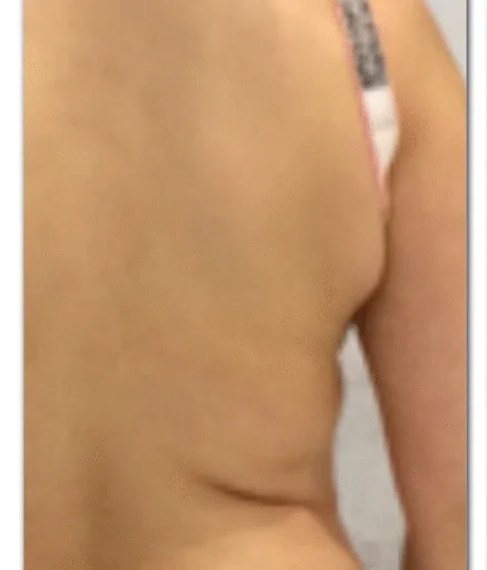 Aqualyx Fat Dissolving on Flanks Before