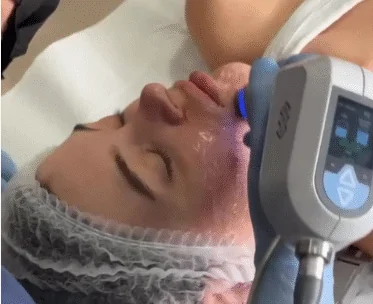 Exilis Elite Face