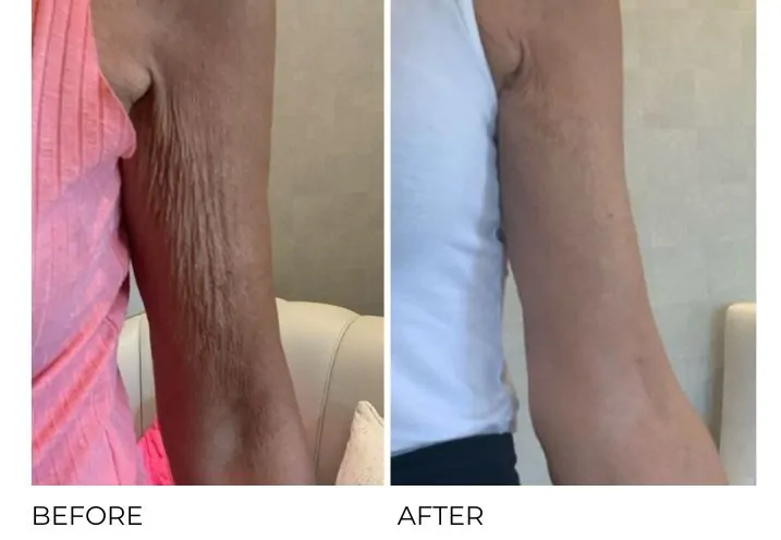 tirzepatide loose skin Tighten Sagging Skin Caused by Weight Loss Injections - Mounjaro, Ozempic,  Wegovy