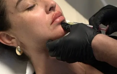 Dermal Filler