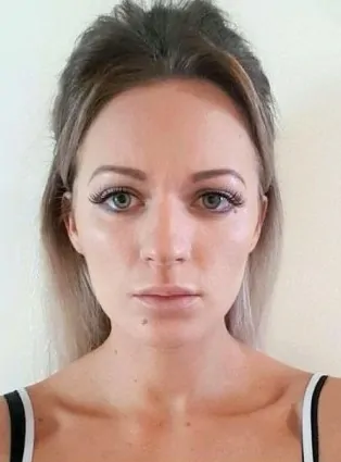 Frown Lines Treatment After