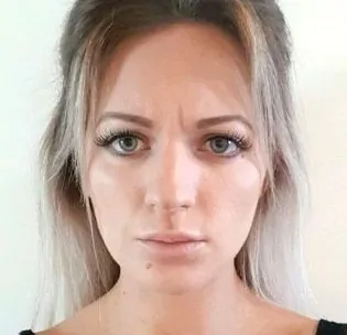 Frown Lines Treatment Before