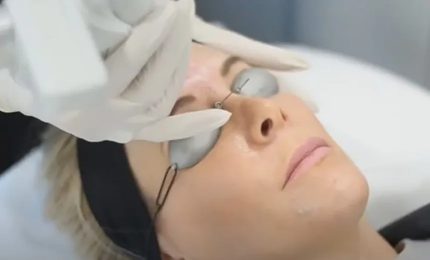 UltraPulse Laser Skin Resurfacing In-Treatment