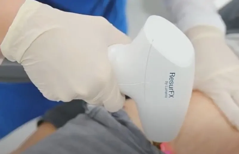 UltraPulse Laser Skin Resurfacing