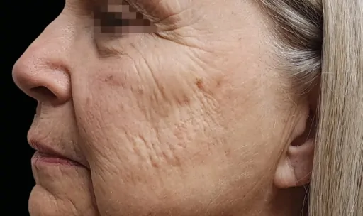 EmFace for Facial Volume Loss Before