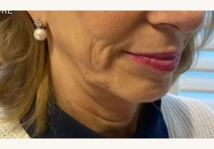 Jawline Augmentation Before