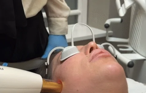 M22 Laser Treatment for Facial Rejuvenation
