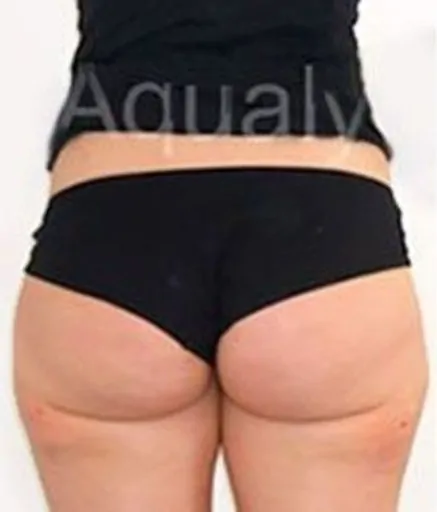 Aqualyx Fat Dissolving After