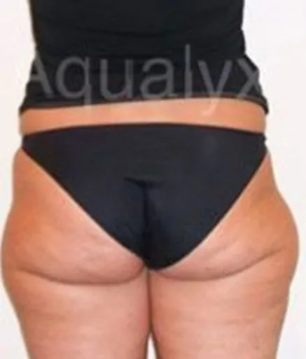 Aqualyx Fat Dissolving Before
