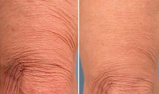 Leg Skin Tightening Before & After