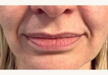 Ultracel on Marionette Lines Before