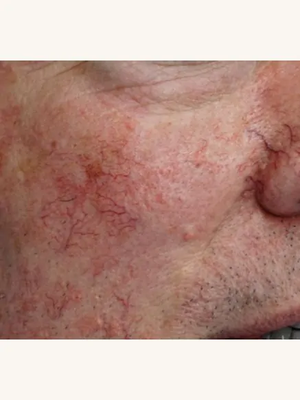 IPL Photorejuvenation on Face Veins with BBL Before