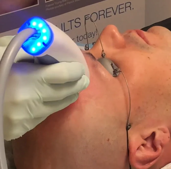 Targeted Moxi Laser Treatment for Men