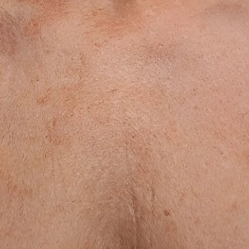 Chest Ultherapy After