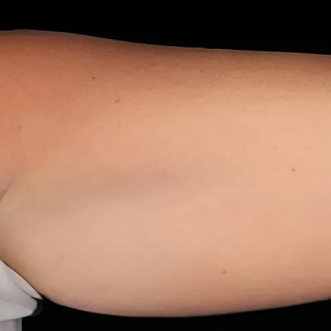 CoolSculpting on Arms Before