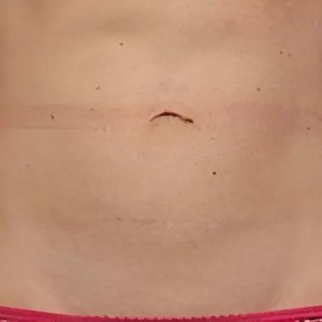 CoolSculpting on Belly After