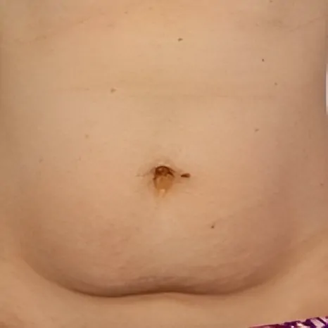 CoolSculpting on Belly Before