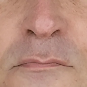 Dermal fillers before and after showing improvement in nasolabial folds and smoother facial contours.