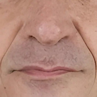 Dermal fillers before and after showing improvement in nasolabial folds and smoother facial contours.