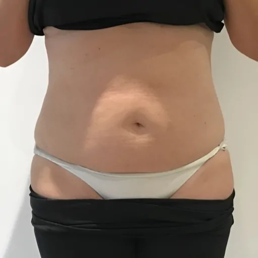Emerald-Laser-Fat-Reduction-After