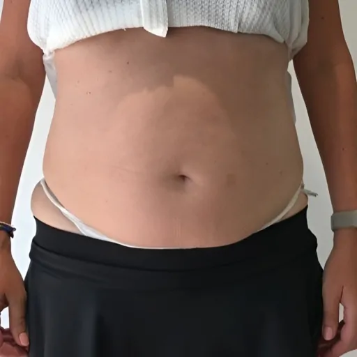 Emerald-Laser-Fat-Reduction-Before