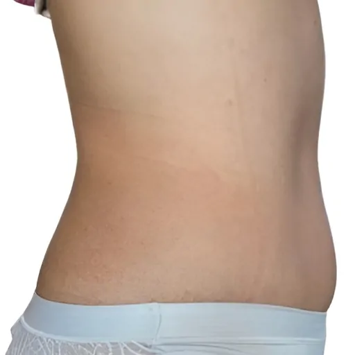 Emerald-Laser-Treatment-on-Stomach-Fat-After