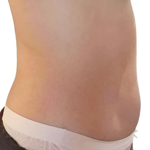 Emerald-Laser-Treatment-on-Stomach-Fat-Before-After