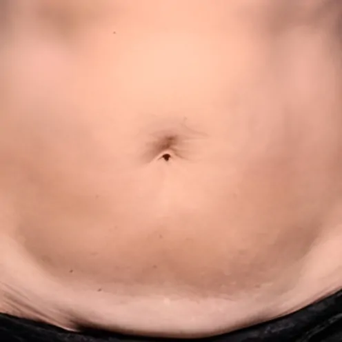 Emerald-Laser-for-Belly-Fat-Reduction-After
