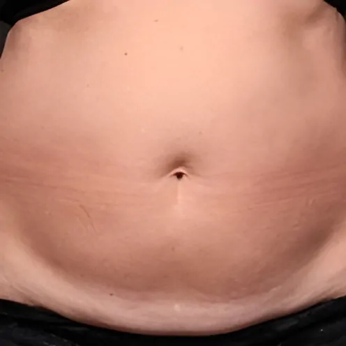 Emerald-Laser-for-Belly-Fat-Reduction-Before