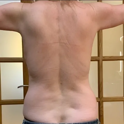 Emerald-Laser-for-Body-Contouring-After